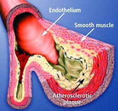 Arterial plaque